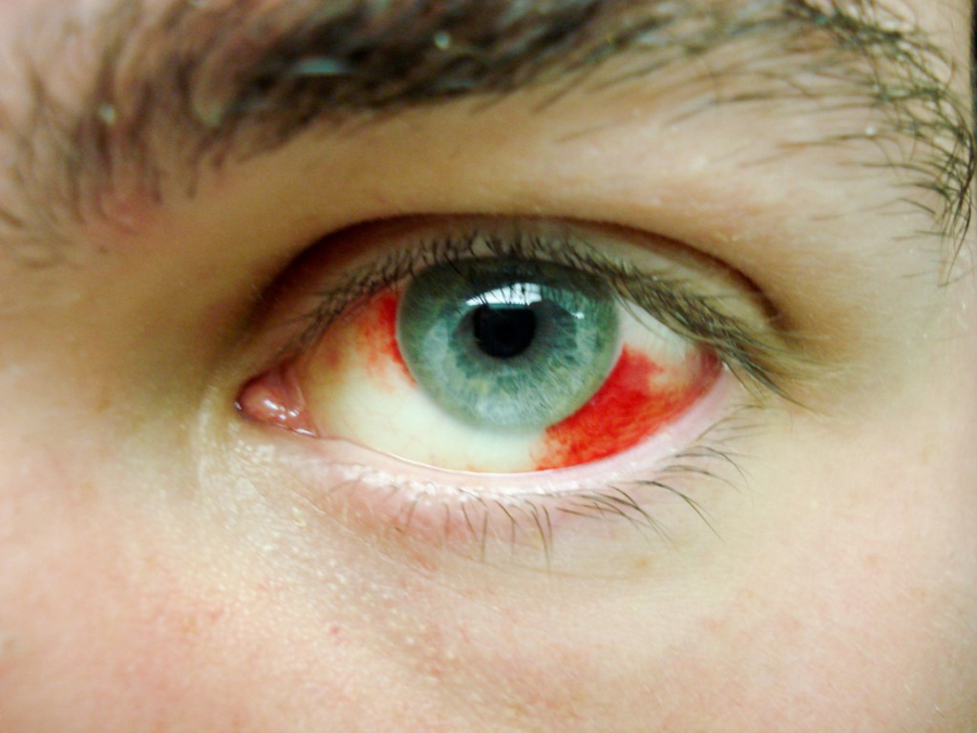 Фото: Первая помощь при кровоизлиянии в глаз